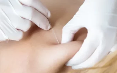 Unlocking Recovery: How Dry Needling and Exercise Transform Treatment for Whiplash