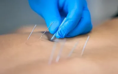 Trigger Point Dry Needling for the Treatment of Myofascial Pain Syndrome: A Comprehensive Guide